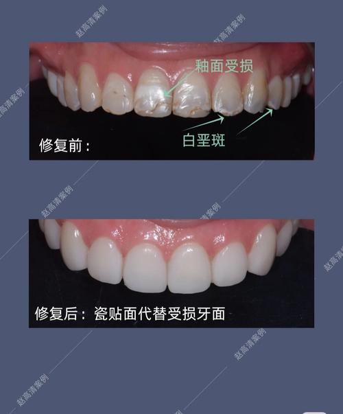 瓷贴面修复方法的关键步骤有哪些？-图1