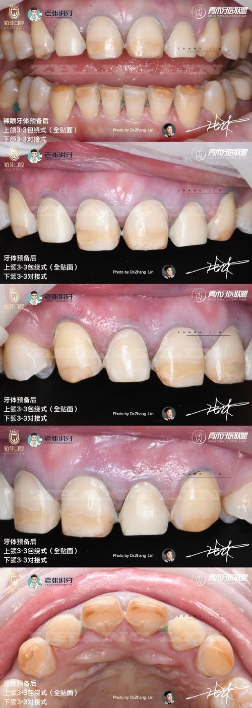 瓷贴面修复方法的关键步骤有哪些？-图3