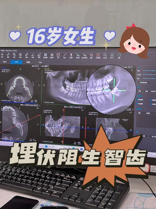 正畸真的能把智齿往前移动吗？-图2