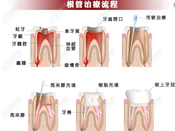 牙齿龋化后，究竟有哪些科学有效的修复方法？-图2
