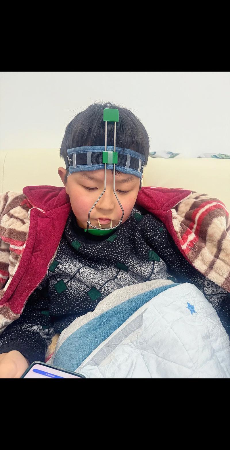 正畸调整中线牵引后头疼是什么原因引起的？-图3