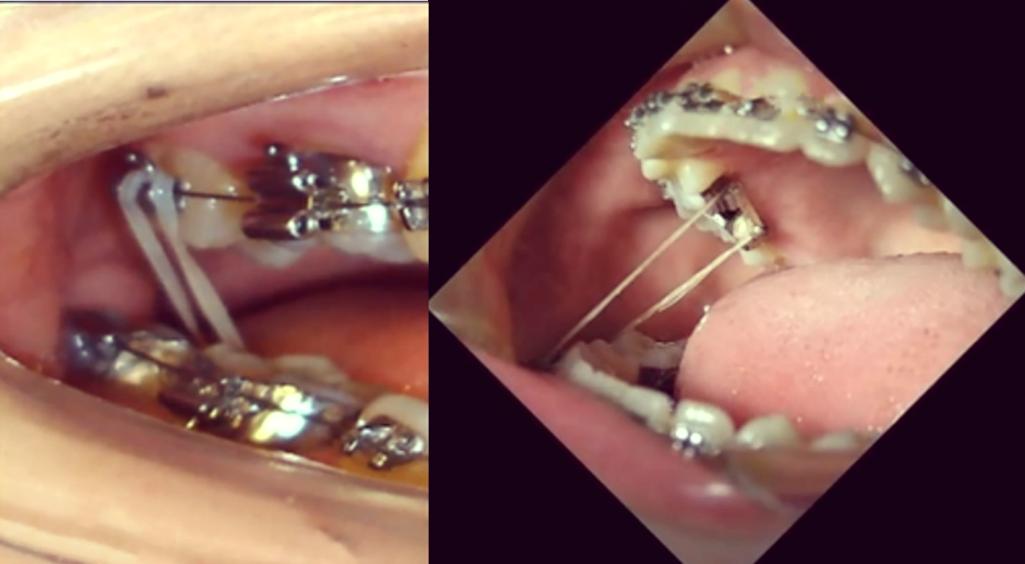 正畸调整中线牵引后头疼是什么原因引起的？-图1