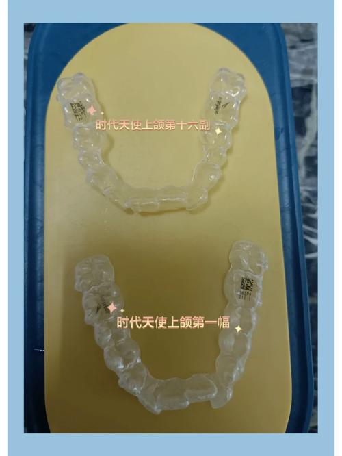 时代天使隐形正畸活动有哪些惊喜福利？-图3