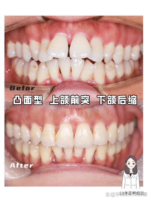 牙齿排列不齐正畸图片-图2
