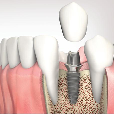 深圳医保种牙费用能报销吗？比例多少？-图3