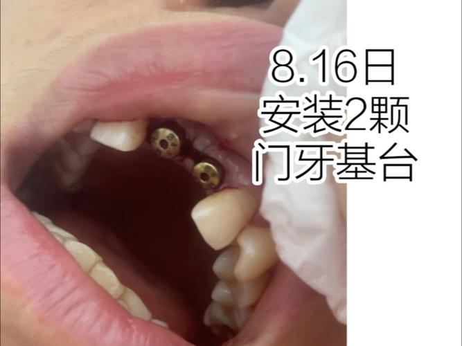 门牙 种牙 过渡-图2