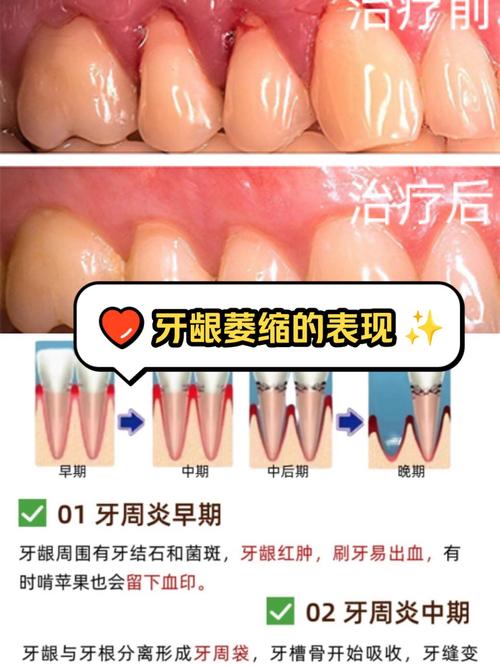 牙周炎没治好就勉强种牙，会有什么后果？-图2