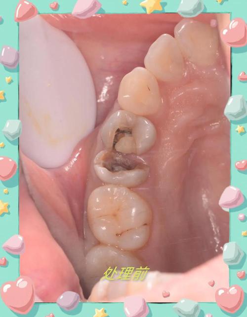 种牙失败还能种吗-图3