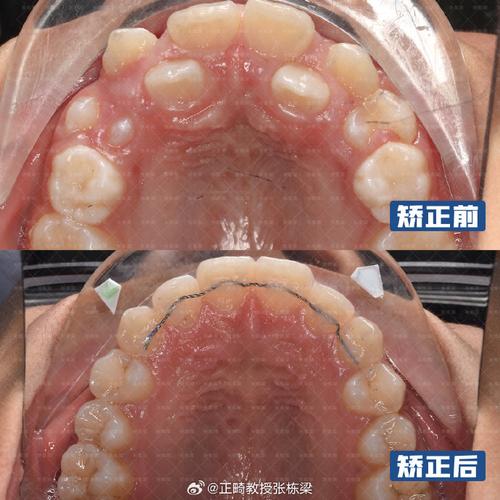 先天缺失下前牙，正畸如何兼顾功能与美观？-图2