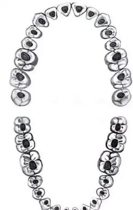 下前牙开髓的临床操作方法与技巧有哪些？-图2