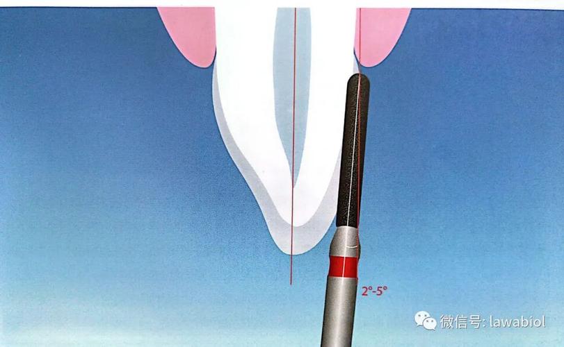 如何精准掌握备牙肩台的操作方法?-图2 如何精准掌握备牙肩台的操作方法?-图2