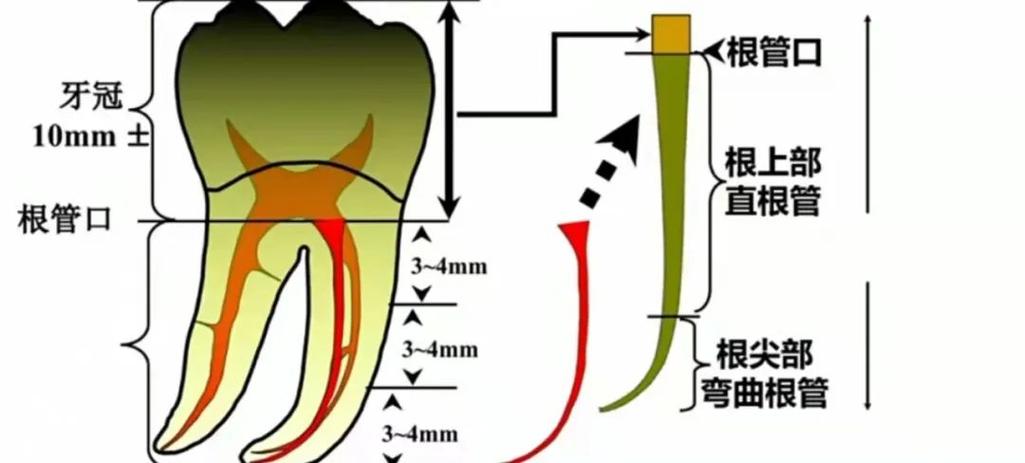 临床中如何精准掌握根管形态识别方法？-图2