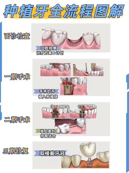 种牙对牙间距的具体要求是什么?-图1 种牙对牙间距的具体要求是什么?-图1
