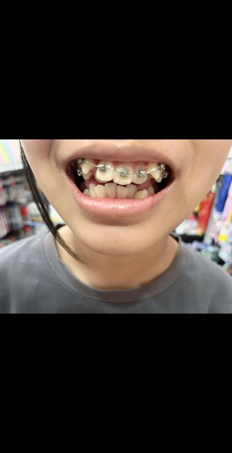 中华口腔正畸网cos病例有哪些典型特点？-图3