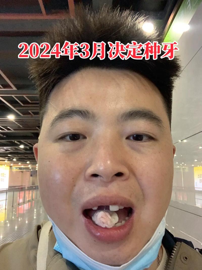 上牙突出拉回矫正后，种牙需要注意什么？-图3