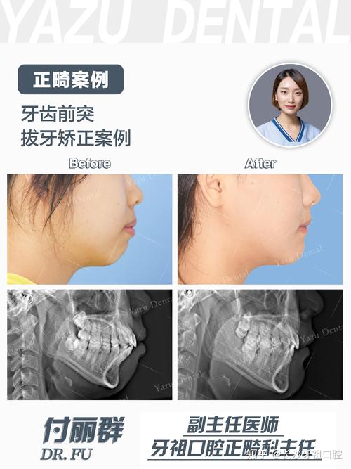上牙突出拉回矫正后，种牙需要注意什么？-图2