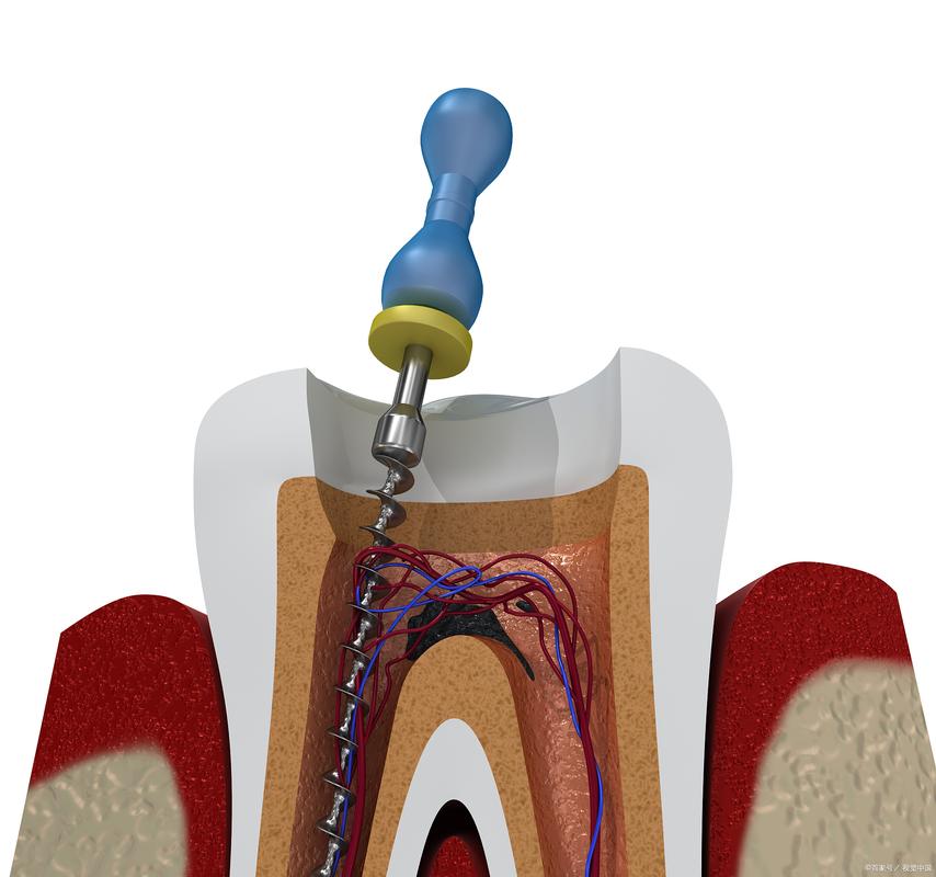 活髓牙麻醉方法有哪些常见选择及适用场景？-图1