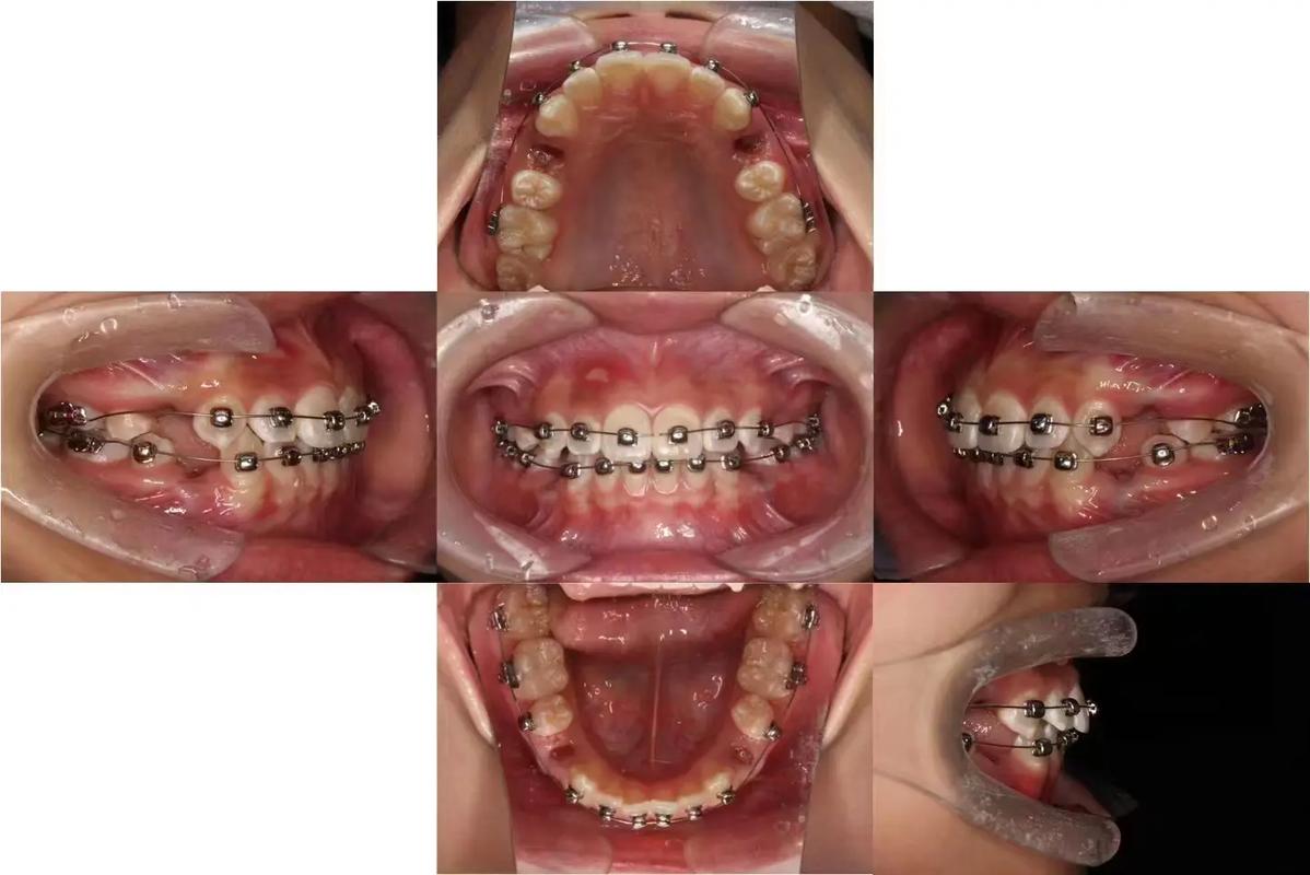 正畸托槽粘结教学视频，如何精准掌握粘结技巧？-图2