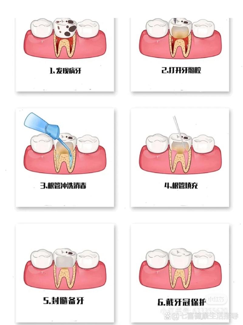 根管换药的具体操作方法及注意事项有哪些？-图3
