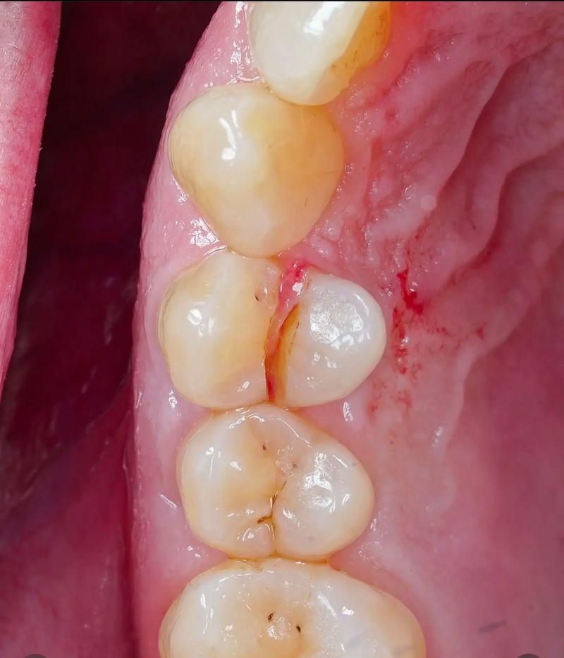 种牙时用自身牙齿有哪些技术优势？-图2