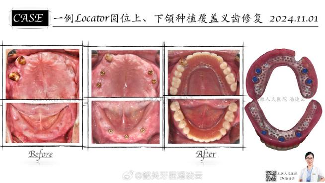 cortex种牙效果好不好？适合哪些情况？-图3