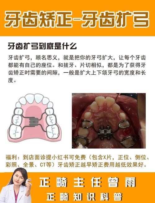 牙科扩弓的常用方法有哪些？-图1