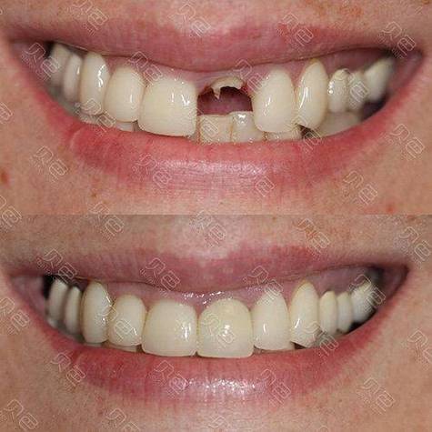 种牙整牙能同时进行吗？效果与风险如何？-图1