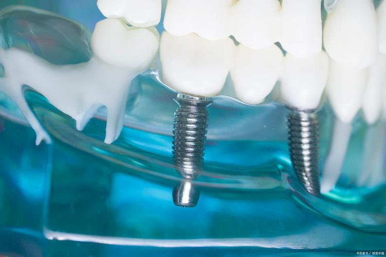 哈尔滨牙博士种牙效果如何？价格贵不贵？-图1