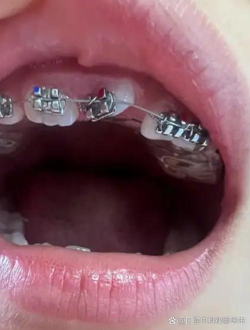正畸结束后门牙为何有点歪？-图2