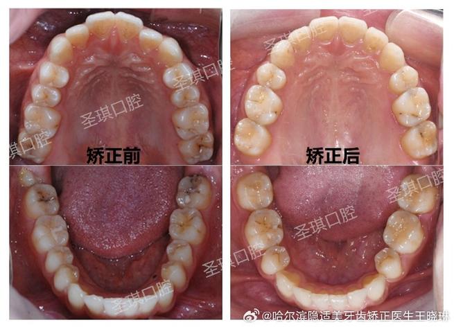 口腔正畸中SNB角度的具体含义是什么？-图3