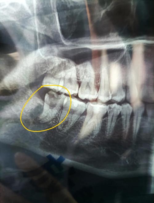 正畸致牙根吸收，患者起诉能获赔偿吗？-图1