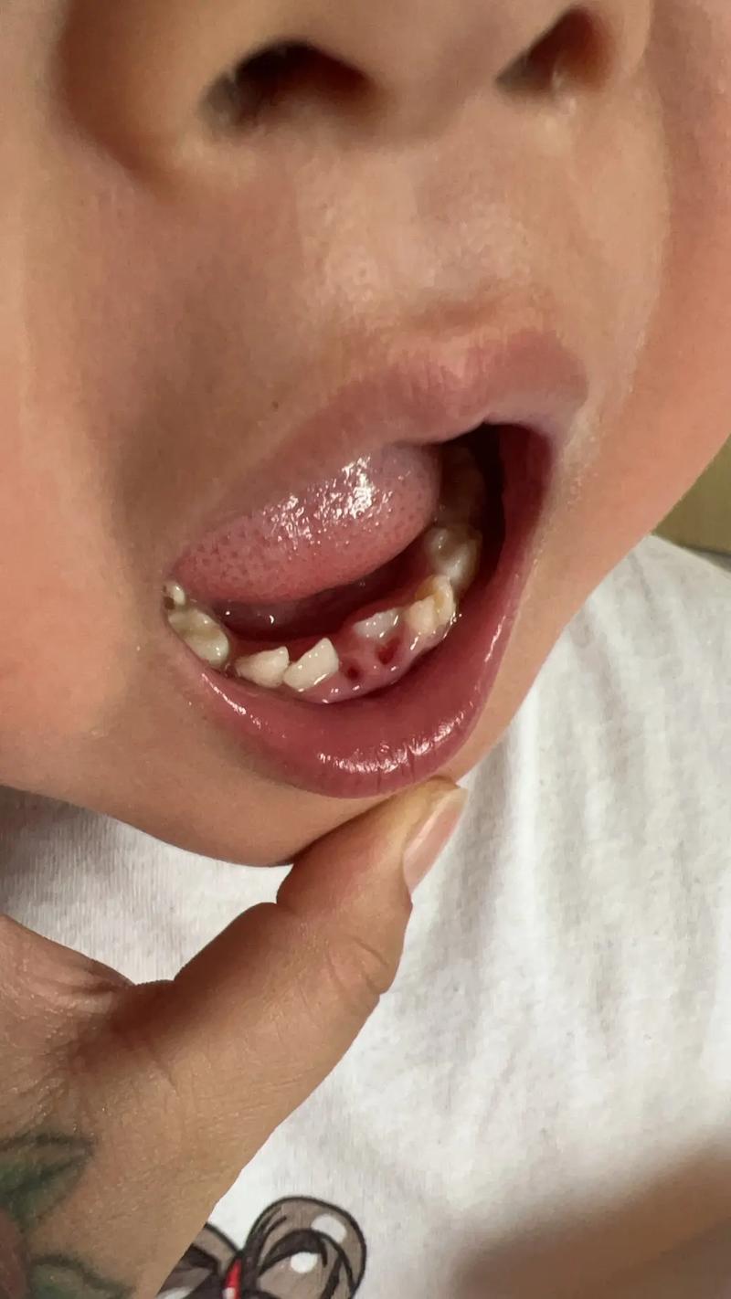 牙医种牙没长出来？是什么原因导致的？-图1