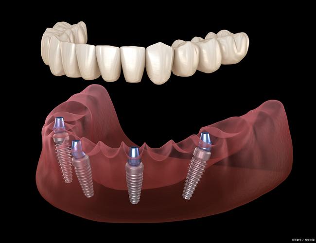 种植牙一次能种几颗?数量受哪些因素影响?-图2 种植牙一次能种几颗?数量受哪些因素影响?-图2