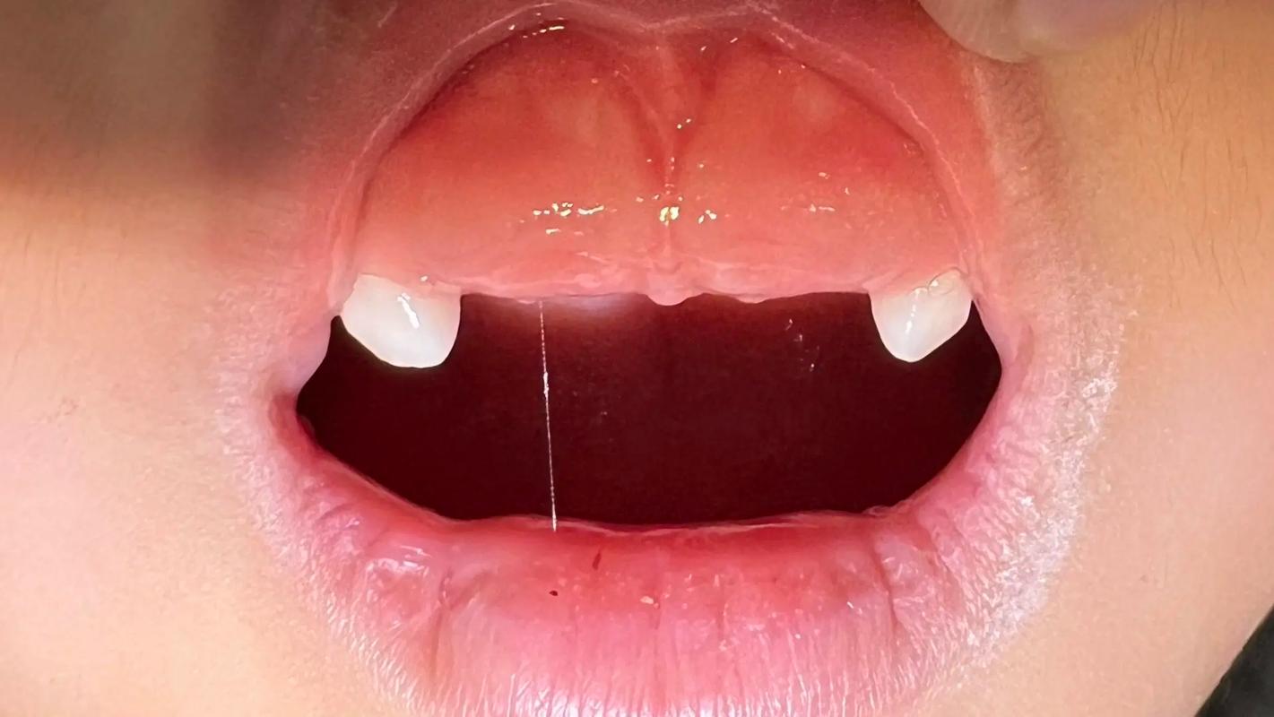 乳牙助萌术的有效方法具体有哪些？-图1