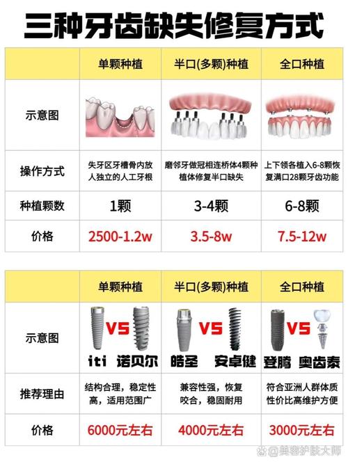种牙种植体怎么选?品牌、效果哪个更重要?-图2 种牙种植体怎么选?品牌、效果哪个更重要?-图2