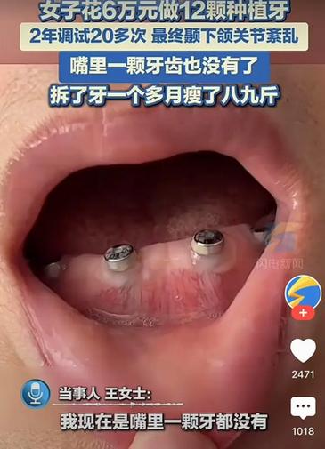 拔牙后为何等一年再种牙?最佳时机有讲究吗?-图2 拔牙后为何等一年再种牙?最佳时机有讲究吗?-图2