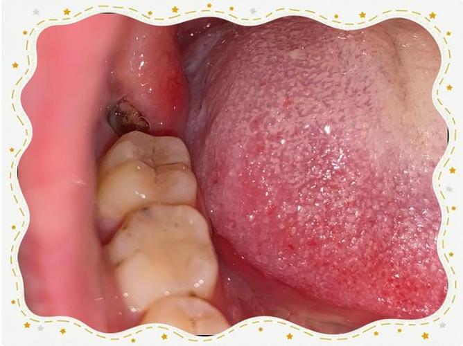 拔牙后为何等一年再种牙?最佳时机有讲究吗?-图3 拔牙后为何等一年再种牙?最佳时机有讲究吗?-图3