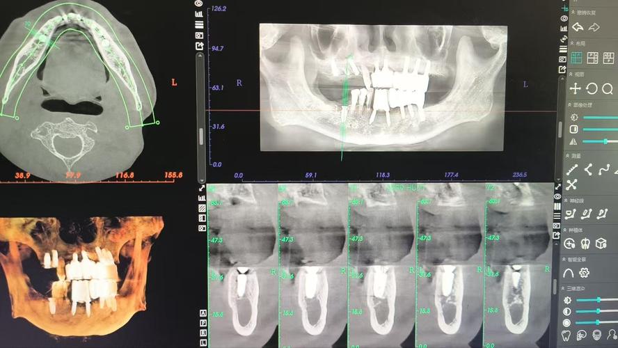 种牙后能做CT检查吗?术后多久可行?-图3 种牙后能做CT检查吗?术后多久可行?-图3