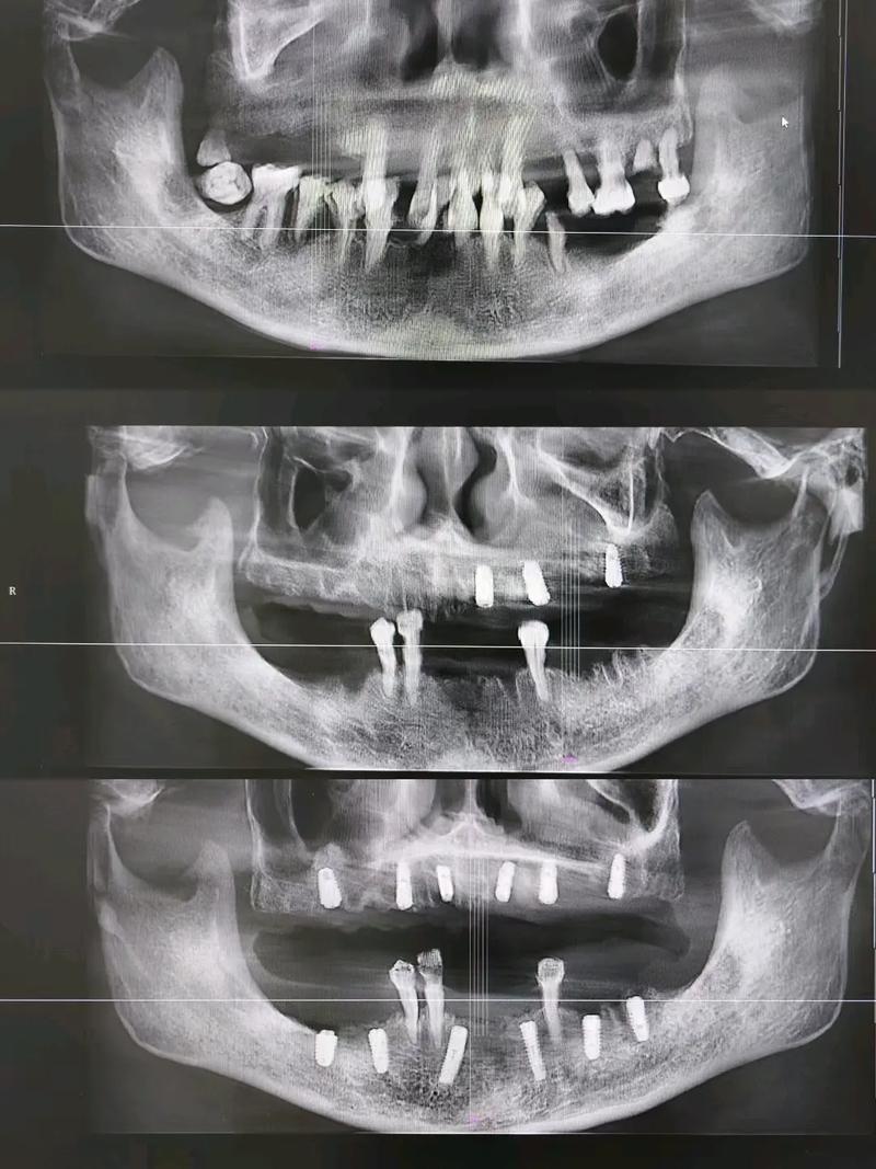 种牙后能做CT检查吗?术后多久可行?-图1 种牙后能做CT检查吗?术后多久可行?-图1