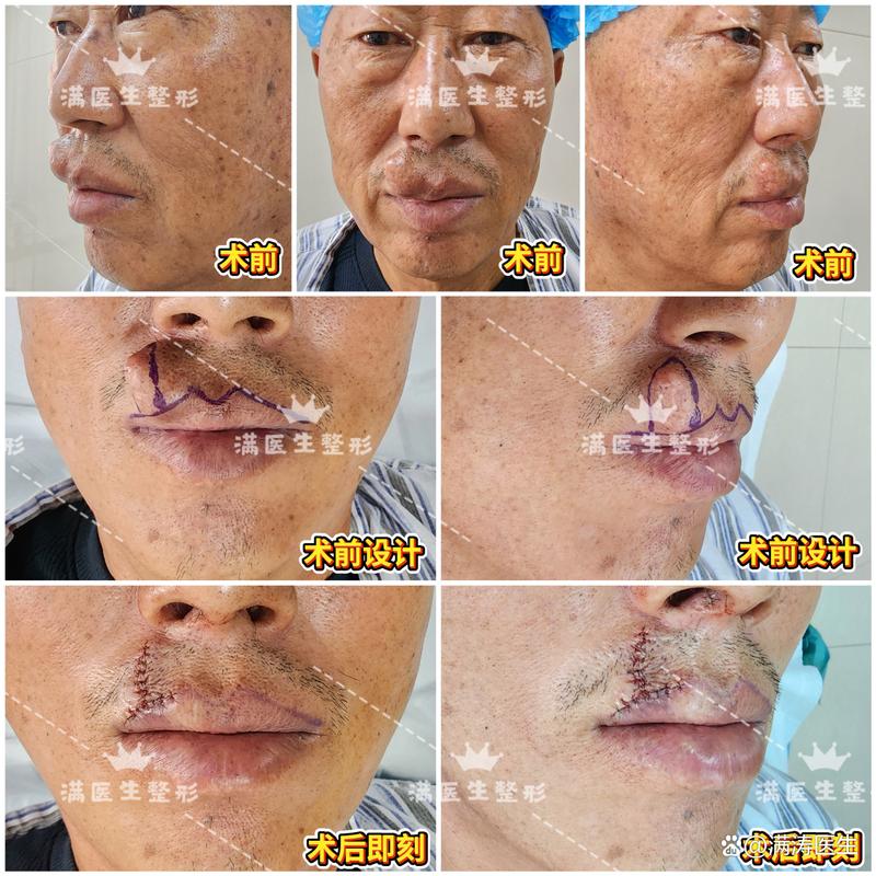 上唇短矫正手术方法有哪些具体类型推荐?-图3 上唇短矫正手术方法有哪些具体类型推荐?-图3