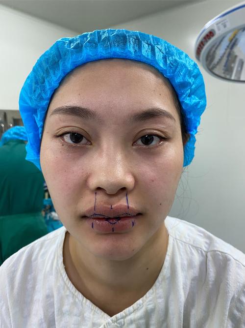 上唇短矫正手术方法有哪些具体类型推荐?-图1 上唇短矫正手术方法有哪些具体类型推荐?-图1
