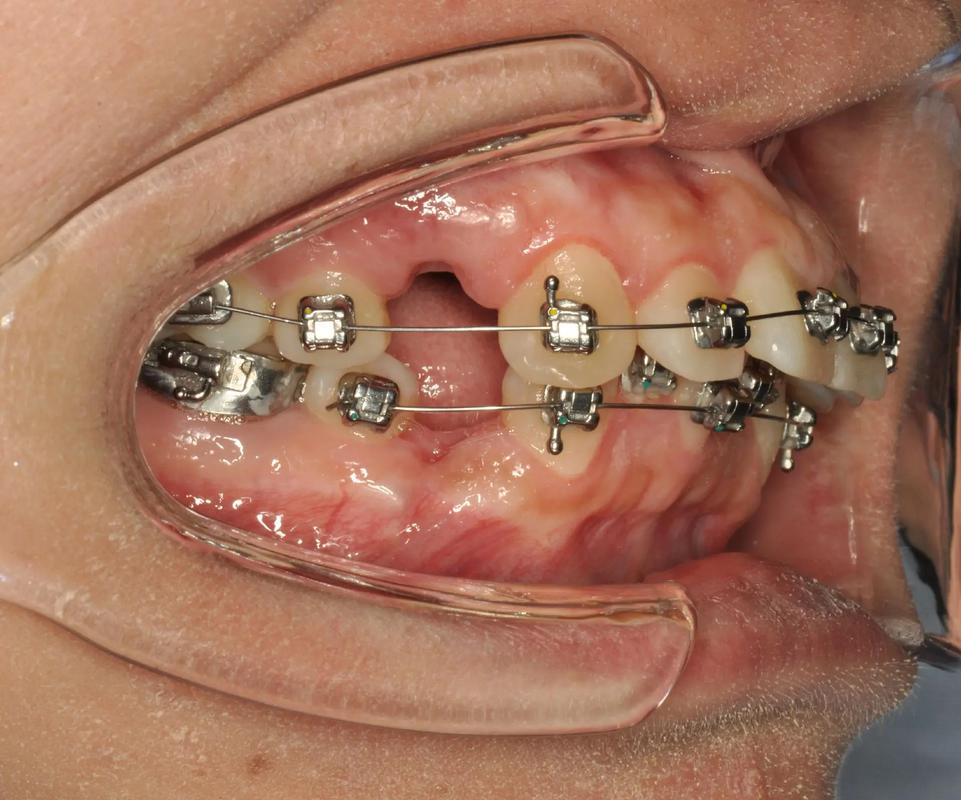 口腔正畸带环焊接视频，操作技巧与注意事项有哪些？-图1