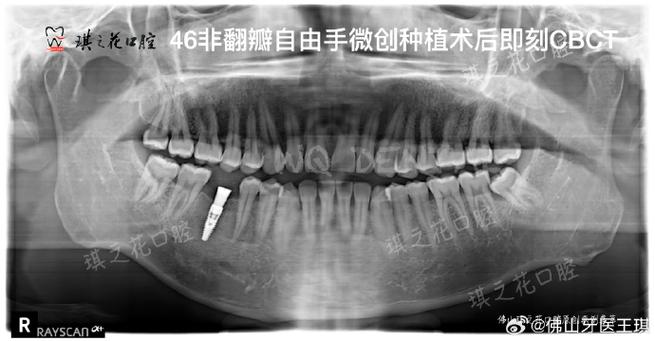 种植牙手术前进行CT检查是必须的吗？-图2