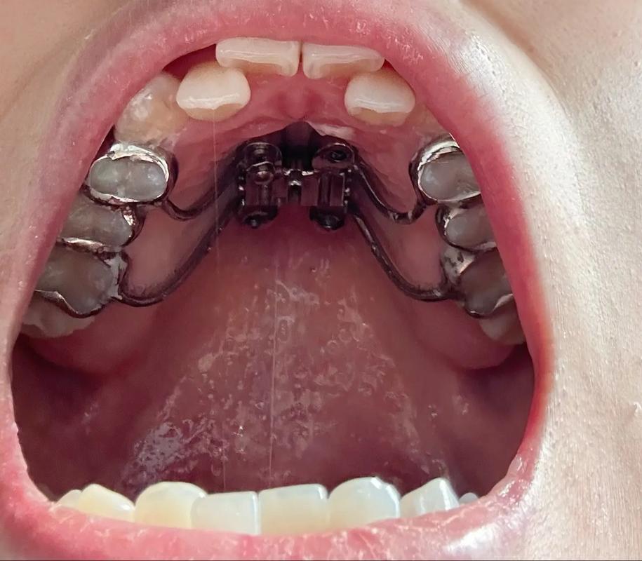 广州番禺正畸牙齿纠正，效果和价格怎么样？-图3