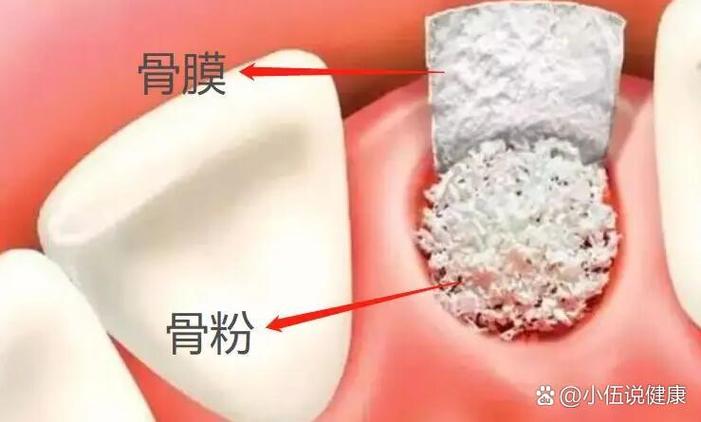 种牙为何要用植骨粉和骨膜？-图1