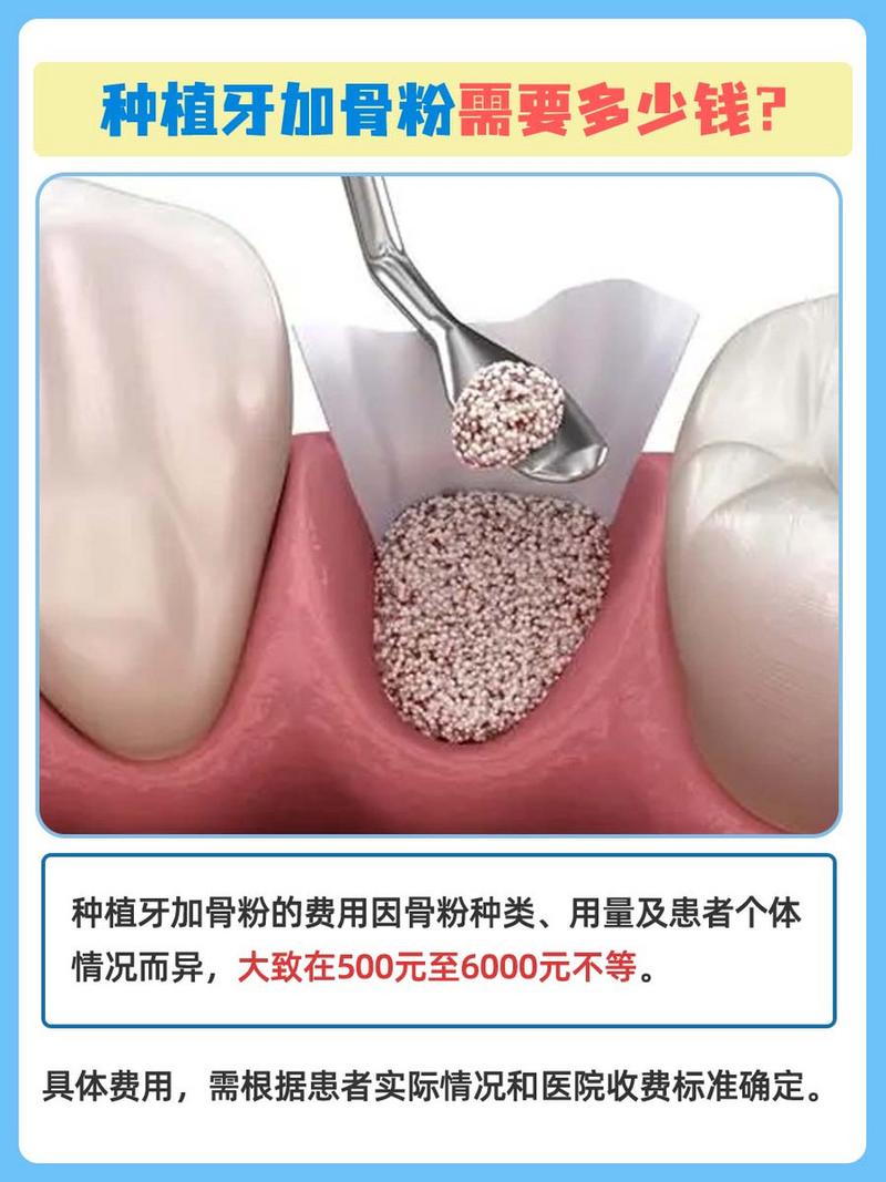 种牙为何要用植骨粉和骨膜？-图2