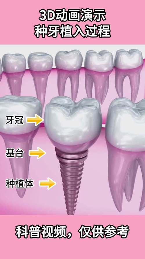 种牙的方式有哪些-图2