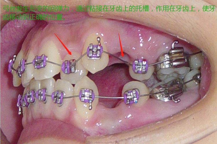 正畸托槽红点指向哪里有什么作用？-图2