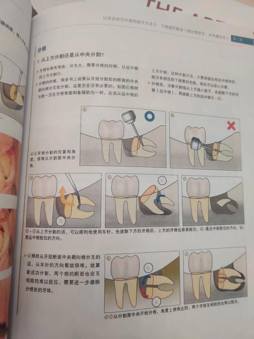 先进拔牙方法如何提升拔牙体验与安全性？-图2