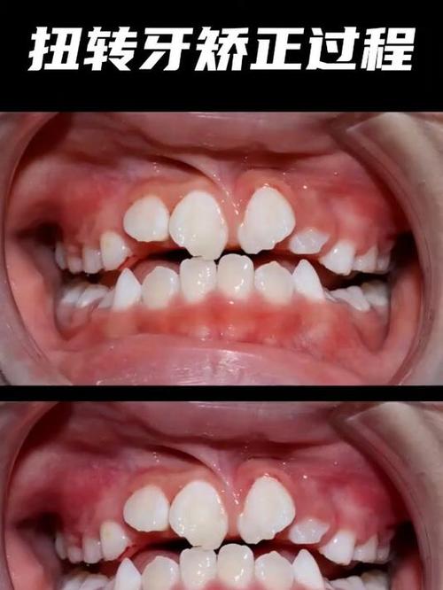 前牙扭转矫正有哪些实用方法？哪种更合适？-图1
